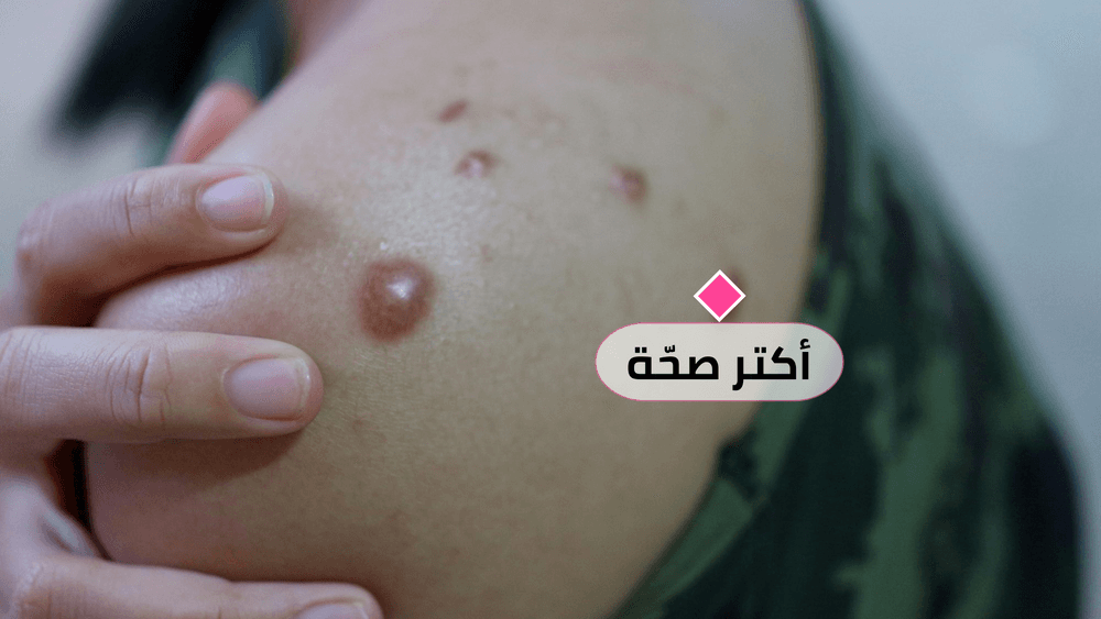 بعد إعلان حالة طوارئ عالميّة: كل ما تريد معرفته عن جدري القرود|