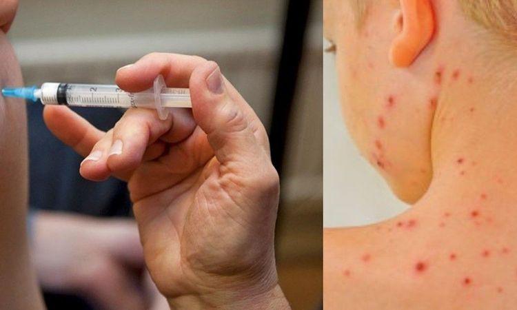 نقاشات حول تعميم لقاح الجدري في السويد