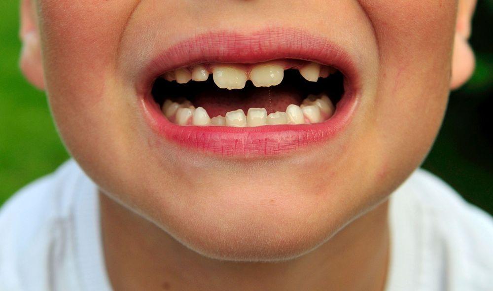 أطفال المهاجرين في السويد أكثر عرضة لتسوس الأسنان
